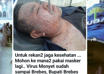 Viral Kabar Pj Bupati Brebes Kena Cacar Monyet Mpox, Benarkah? Cek Faktanya!