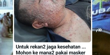 Viral Kabar Pj Bupati Brebes Kena Cacar Monyet Mpox, Benarkah? Cek Faktanya!
