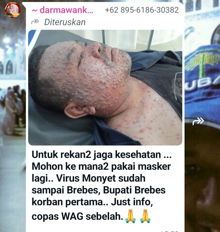 Viral Kabar Pj Bupati Brebes Kena Cacar Monyet Mpox, Benarkah? Cek Faktanya!