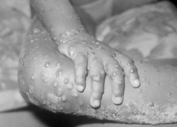 Waspada Warga RI, Cacar Monyet (Mpox) Sudah Sampai Negara Tetangga