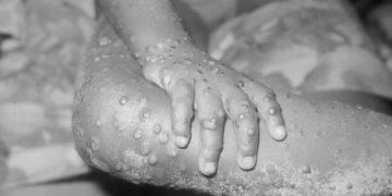 Waspada Warga RI, Cacar Monyet (Mpox) Sudah Sampai Negara Tetangga